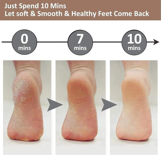 Electric Callus remover for dead skin removal -1 pc